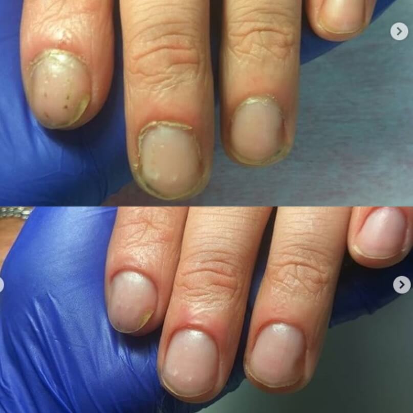 Доктор по ногтям. Маникюр до и после. Ногти до и после. Ногти до маникюра. Маникюр на короткие ногти до и после.
