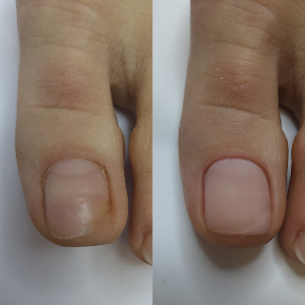 Травмы, отслоение ногтей, протезирование ногтей